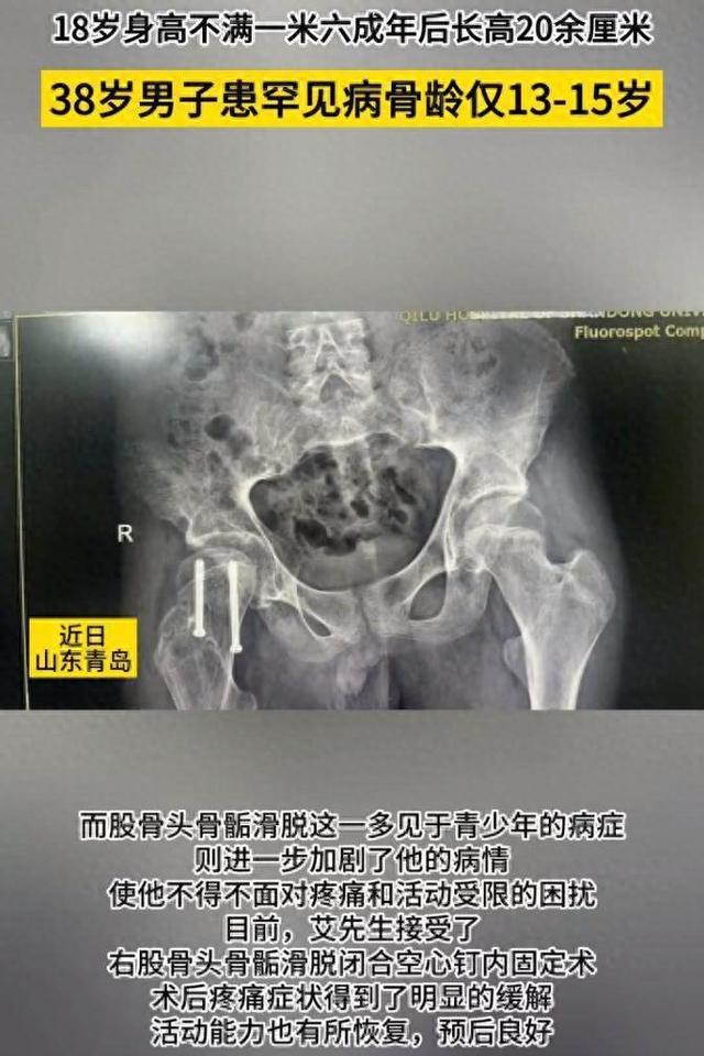 38岁男子成年后又长高了20厘米，原因找到了