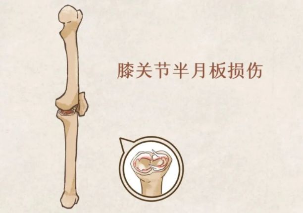 一运动膝盖就疼？当心半月板磨损！这些知识需了解